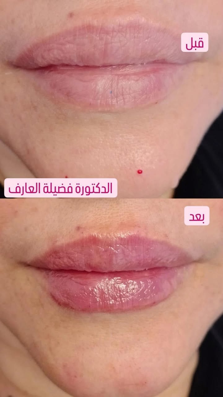 د. فضيلة العارف ❤️
غنيه عن #التعريف قمه الاخلاق والتعامل الراقي والشغل الممتاز من كل 
النواحي تجميل اطفال نسائية

  د. فضيلة العارف
عمليات #جراحية وغيرها💋✅
متقصر ويا كل #المراجعين واي احد عنده استفسار متقصر ويا ولكل مجربها ويعرفها 
تتواجد حتى في ايام العطل ✅✅
قسم من شغلها بالتجميل والفلر ✅⬇️
ماعليكم بس تجون #تفحصون حتى التحاليل توصل الكم ع واتساب اكيد تحاليل  من عيادات الوتد الطبية في بسماية
مختبر الوتد الطبي التخصصي في بسماية اضبط تحاليل واجهزة حديثة والنتيجة سريعة والعلاج ايضاً يوصل الكم للباب من مجمع وتد بسماية الطبي التخصصي  والتوصيل مجاني ايضاً 💋💋
تتواجد يومياً العنوان /الشارع العام مجاور سدن ستور وصيدلية الوتد الحجز خاص او على الرقم ***********
