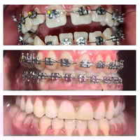 تقويم اسنان • عضة أمامية مفتوحة • الشعب شارع عدن