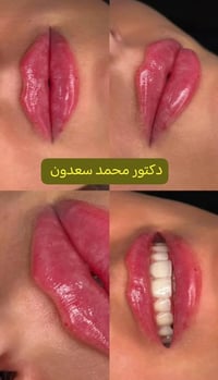 عرض خاص فلر فرنسي السيسي 25 ألف العنوان مدينة الصدر الكياره قطاع٦٧ مقا...