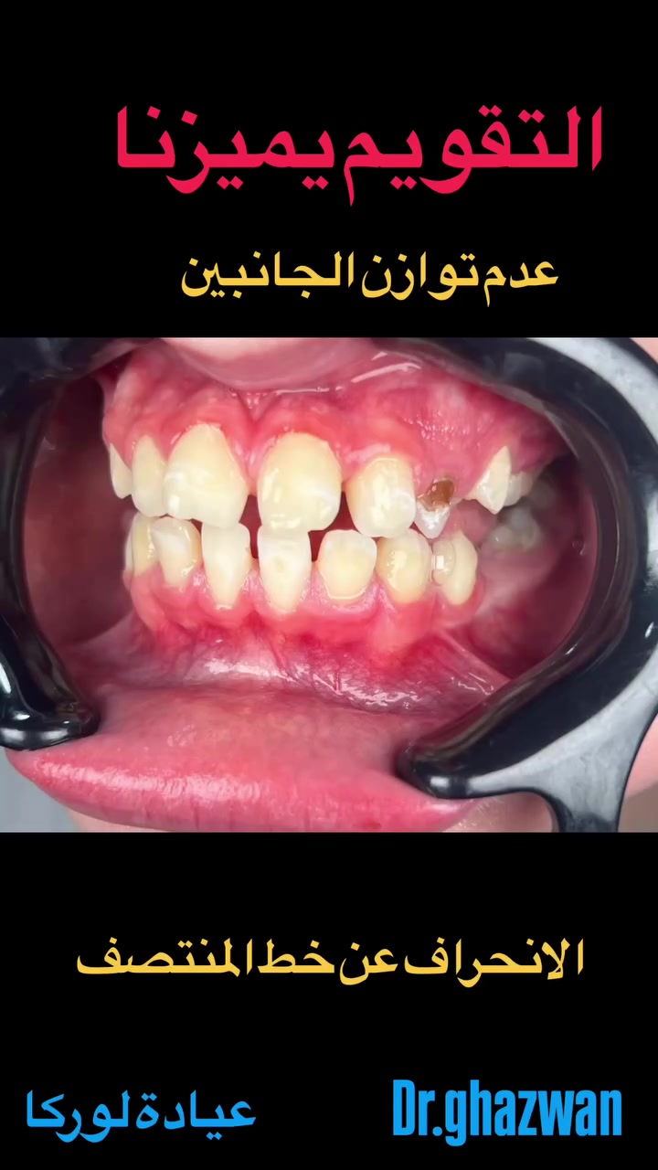 التقويم يميزنا احد الحالات المعقدة و المستعصية عدم توازن الجانبين يعاني من مظهر خارجي غير متناسق و غير مرغوب جدا … علاج جميع الحالات الصعبة و المستعصية نتائج مضمونة دقة عالية انتظام متناسق للمظهر الخارجي جمالية فائقة طرق طبية … دكتور غزوان مزهر بغداد الكرخ نفق الشرطة بداية شارع الاطباء عيادة لوركا فوق صيدلية كنز النفق متوفر واتس *********** #تقويم_الأسنان_والفكين #تقويمالأسنان #تقويم_الأسنان_بأنواعه #تقويم_الشفاف_للأسنان #تقويم_الأسنان_قبل_وبعد @تقويم_الاسنان @تقدم_الفك_السفلي @العضة_المعكوسة @العضة_المفتوحة
