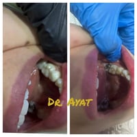 بناء وترميم وتغليفات زاركون ثابته لمراجعتنا الغاليه  بلون رحى طبيعيه ل...