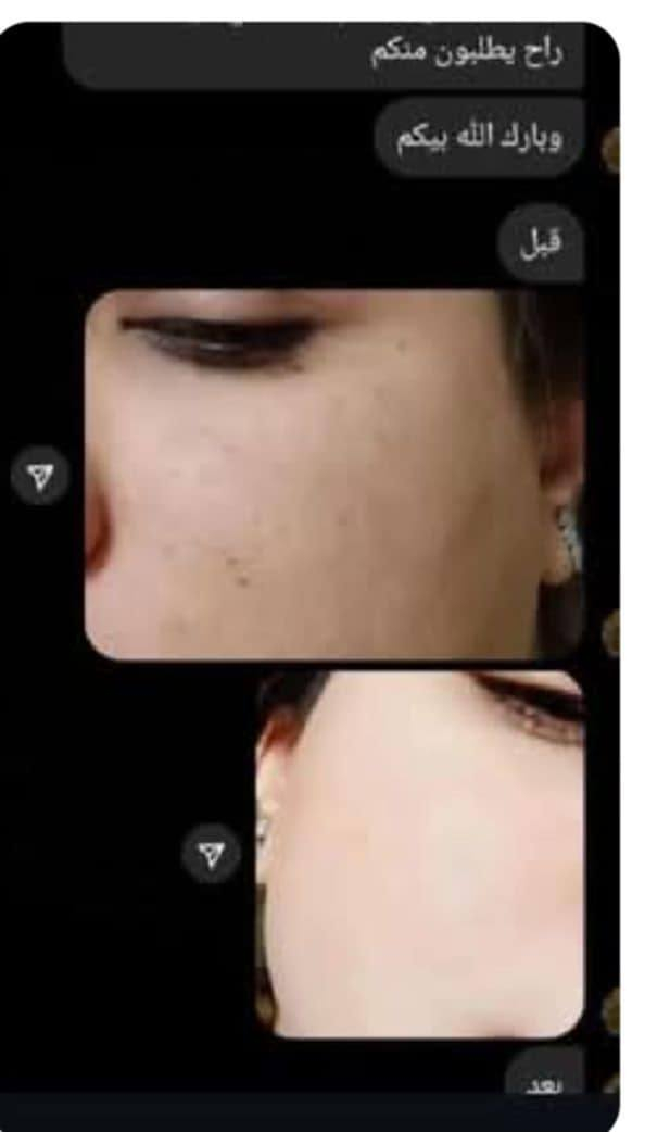 بديل أبرة البوتوكس والفلر.
مفاجأة تخفيضات لفتره محدودة. 

وداعاً للوجه النحيف والتجاعيد 
كريم موضعي لمكافحة الشيخوخة 
 المنشأ امريكي 
والآمنة تماماً بنسبة 100% والحاصلة على براءات  اختراع

‌‌اعزائي هذا المنتج يعمل على 

‌‎1-إمتلاء البشرة بالكولاجين
الطبيعي وتسيمن الوجه 
2-إخفاء جميع التجاعيد وانواع الكلف 
‏3-‎إخفاء انتفاخات تحت العين
4-إخفاء حفر وديفوهات الوج 
5-إخفاء اثار الجروح القديمه
6-إخفاء خطوط الجبهة
7-إخفاء علامات الأبتسامة
يعادل 25 جلسة تجميلية 

للحجز والاستفسار / راسلو الصفحة الان علماً ان التوصيل مجاني لجميع محافظات العراق •• سامراء, صلاح الدين


**إذا كنت صاحب هذا الإعلان وتريد حذفه لأي سبب، رجاءا أرسل رسالة إلى الدعم الفني**
