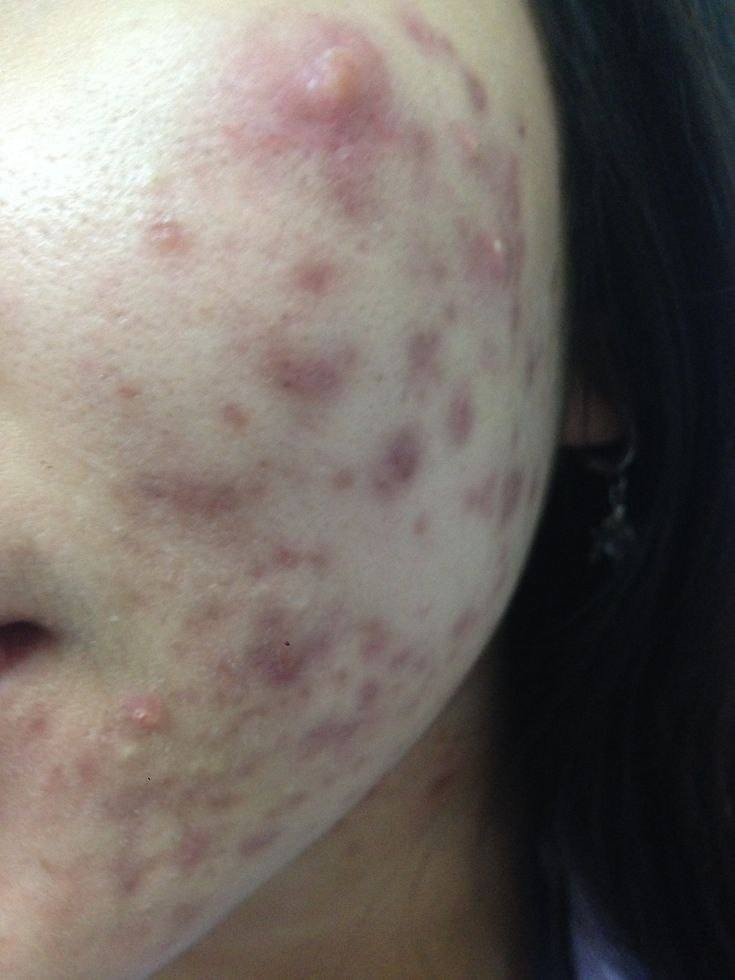 عندج حبوب بالوجه ومأذية بشرتج؟ استخدمي غسول وكريم من لاروش بوزيه!" 🛑
يعالج الحبوب من الجذور ويمنع ظهورها مرة ثانية. متوفر عدد قليل جداً، لا تفوتين الفرصة يوجد خدمة توصيل لجميع محافظات العراق #الاصلي


**إذا كنت صاحب هذا الإعلان وتريد حذفه لأي سبب، رجاءا أرسل رسالة إلى الدعم الفني**