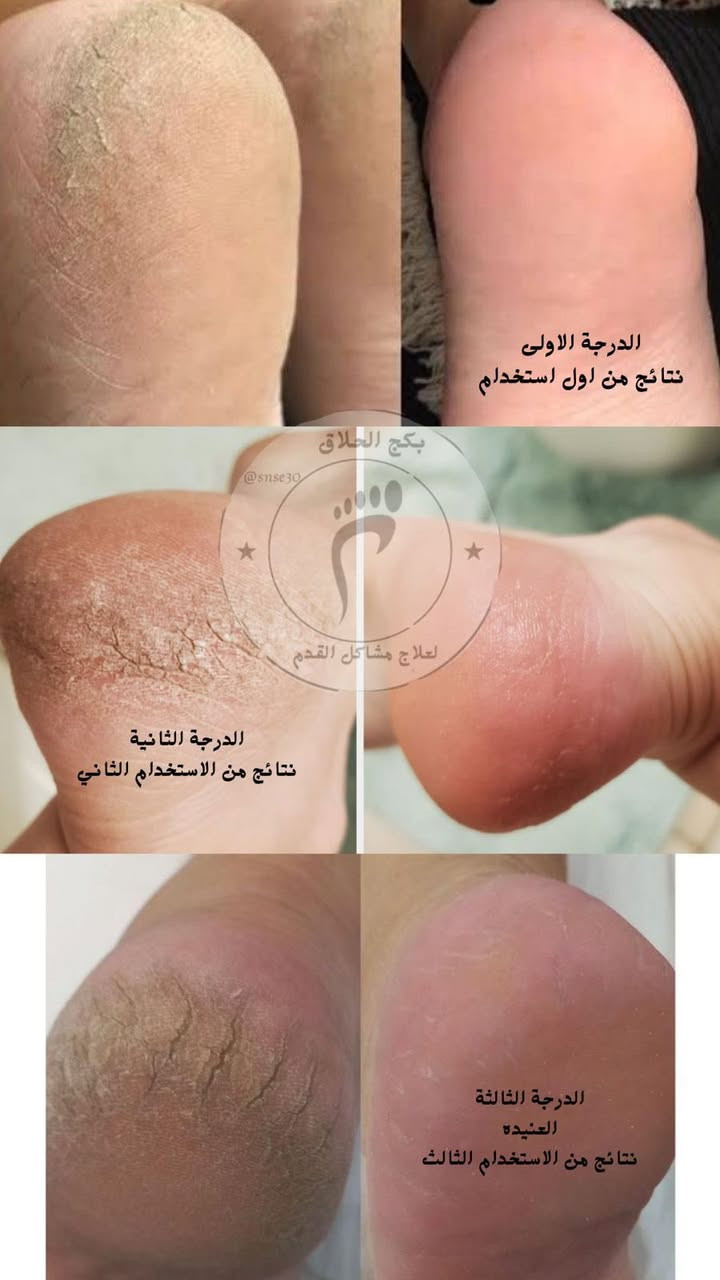 تعبت من التشققات اللي توجعك أو شكلها مو حلو؟ جربت هواية كريمات وما فادت؟اليوم جايب لكم الحل بكج كامل++ (عن تجربة شخصية وضمان اذا ما شفت فرق من اول استخدام ترجع المنتج وترجع فلوسك]

✅ مناسب للرجال والنساء.
✅ فعال جداً للناس اللي توقف هواية أو تمشي مسافات.
✅ نتائج حقيقية وملموسة من أول أيام.
السعر 15 الف
[التوصيل داخل مدينة الصدر 3 الالف خارج المدينه 5]
للحجز والاستفسار
واتساب ***********
