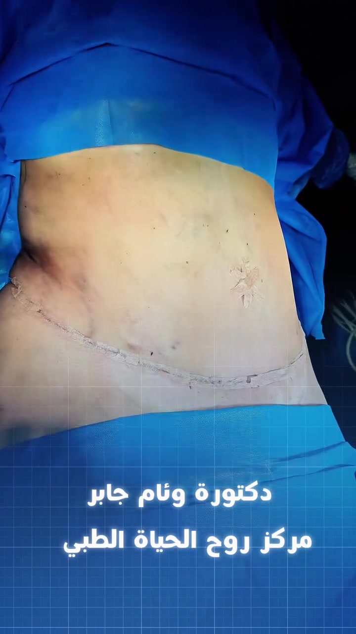 ✨ عملية شد بطن بعد الجراحة مباشرة ✨  

على يد الدكتورة وئام جابر  
👩‍⚕️ اختصاصية الجراحة التجميلية والترميمية  

نتائج أولية واضحة 👌  
وقوام أكثر تناسقًا وثقة 🤍✨  

📍 الموقع: العزيزية – شارع الخليج – جانب البوابة  
📞 الهاتف: ***********  

مركز روح الحياة الطبي  
جمالك يبدأ من هن
