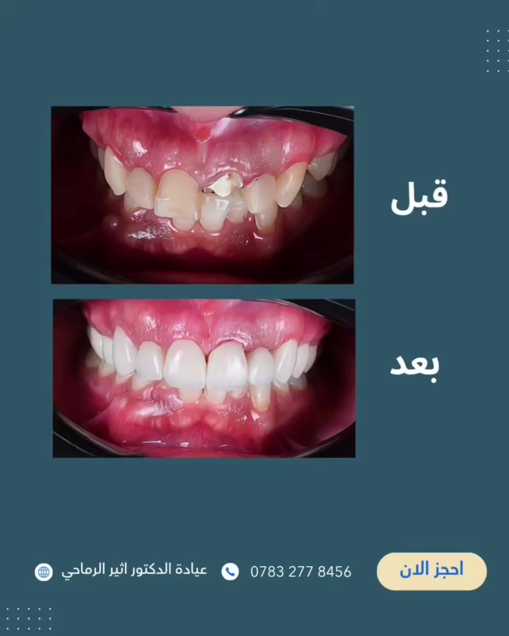 تحویل حالة سن مکسور إلى ابتسامة متناسقة علاج جذور + حشوة تجميلية + تاج زیرکون
✅ للحصول علی نتيجة طبيعية وجميلة.

(عيادة الدكتور أثير الرماحي)

☎️ للحجز والاستفسار ***********

📍الموقع 
الديوانية- قضاء عفك/شارع الأطباء قرب صيدلية أكرم البديري بناية الدكتورة مروة حمود التميمي الطابق الثاني

#تجميل_الأسنان #تغليف_زیركون 
#ابتساة_هوليود #عيادة_اسنان #الديوانية_قضاء_عفك
