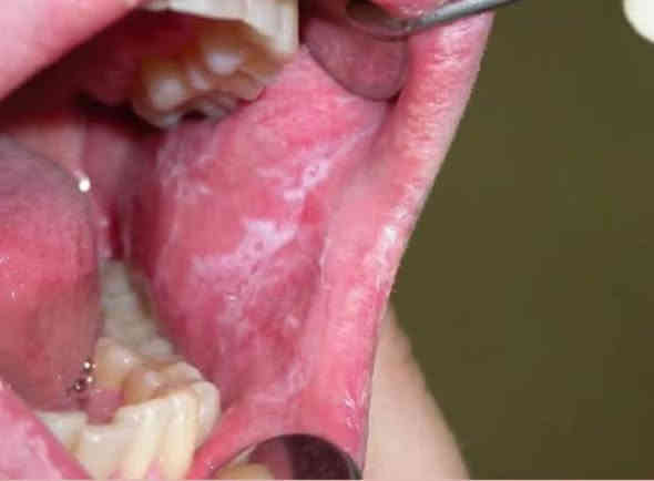 السلام عليكم ، اذا احد عنده هيج حالات بالفم ف يتواصل وياي ، واي شي يشوفه مو طبيعي داخل الفم يدزلي صورته حتى نحدد موعد للعلاج
***********
