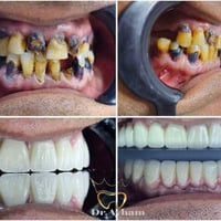 نخور معممة • علاج جذري • تغليف كامل