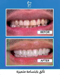 طويريج • تبييض أسنان • عروض راس السنة