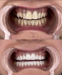 ورجعنالكم العرض المميز  على ابتسامات المشاهير  لمدة ٣ ايام فقط  السن ا...