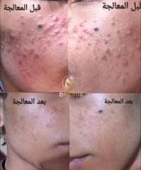 معالجة حب الشباب بيد الدكتورة هدى علي كاظم اختصاص جلدية وتجميل  في مرك...