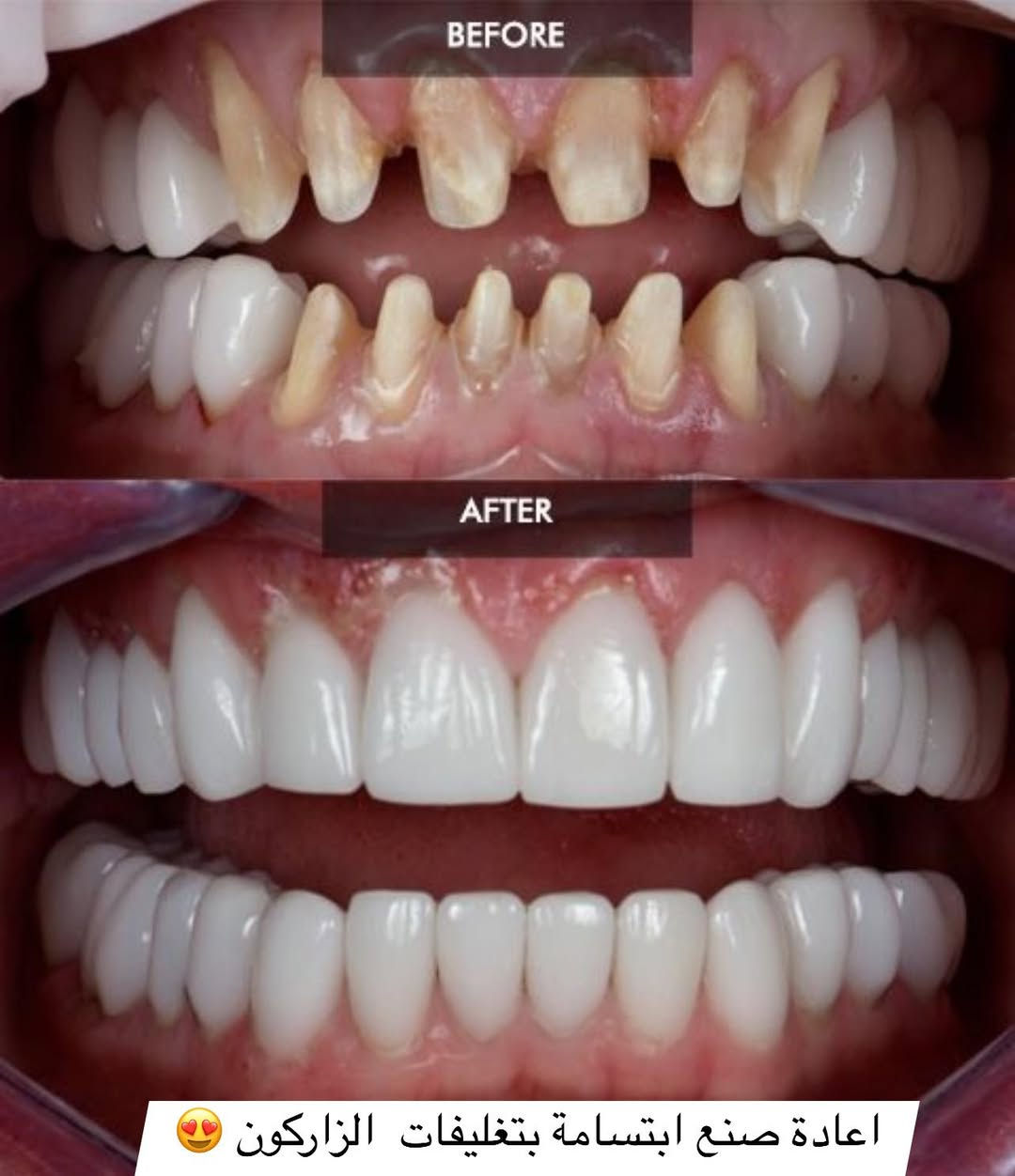 حتى أصعب الأسنان متصعب علينا ✨🦷
شغلنا مو بس علاج… شغلنا دقة ونتيجة تخلّي ابتسامتك غير 💙

ومن شغلنا لهل أسبوع 👇
✔️ حشوات أمامية تجميلية
✔️ حشوات جذور للأسنان الخلفية ويا إعادة بناء السن
✔️ تغليفات زاركون وإيماكس
✔️ تنظيف وإزالة تصبغات

وبما إن عروض الشهر اللي فات عجبتكم كلش ❤️

💥 رجعنالكم بعرض أقوى هالشهر 💥

🎊 أول حجوزات ليومي الثلاثاء والأربعاء🆎:
✨  الهم جلسة تنظيف  وتلميع مجانية

* بالإضافة عروض حلوة ومميزة داخل العيادة على باقي الخدمات

⏱️ العرض محدود وعلى أول حجوزات بس!

📞 للحجز: ***********
او ع الدايركت 
🕓 من 4 العصر للـ 9 مساءً

💙 غايتنا رضاكم وثقتكم
ويا عيادة الجمال… ابتسامتكم تصير أحلى 😍✨
