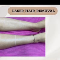 ليزر ازالة شعر • شعر كثيف • العبيدي شارع الاطباء