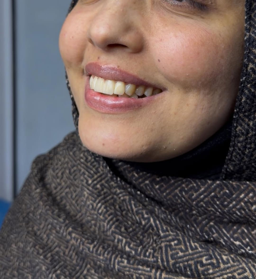 مو كل ابتسامة تنولد صح… بس الصح نعرف شلون نصلّحها 😌🦷

مراجعتنا جانت تعاني من تركيب أسنان سابق خطأ
❌ عدم تطابق
❌ صفر بالأسنان
❌ كسر وتشوه بالشكل
❌ ابتسامة مو مريحة لا نفسياً ولا شكلياً

📌 استلمنا الحالة من البداية
• شلّينا التركيب القديم بالكامل
• قيّمنا الحالة بدقة
• سوّينا تركيب جديد مدروس صحياً وجمالياً
• ركزنا على التناسق، الراحة، والابتسامة الطبيعية

✨ النتيجة؟
ابتسامة مرتّبة، ناعمة، وتفتح النفس
تركيب يليق بالوجه… مو مجرد أسنان!

💡 لأن الفرق مو بالتركيب
الفرق بالخبرة، التشخيص الصح، والشغل النظيف

📍 إذا عندك تجربة سابقة فاشلة
📍 إذا خايف/ة تعيدين الغلط
📍 إذا تريد ابتسامة ترجع ثقتك بنفسك

احنا هنا حتى نصلّح مو نجرّب ✔️

📞 للحجز والاستفسار:***********
📩 راسلينا خاص

#تصحيح_تركيب
#ابتسامة_تفرق
#طب_الأسنان
#حالات_قبل_وبعد
#ثقة
#SmileMakeover
#DentalCare
