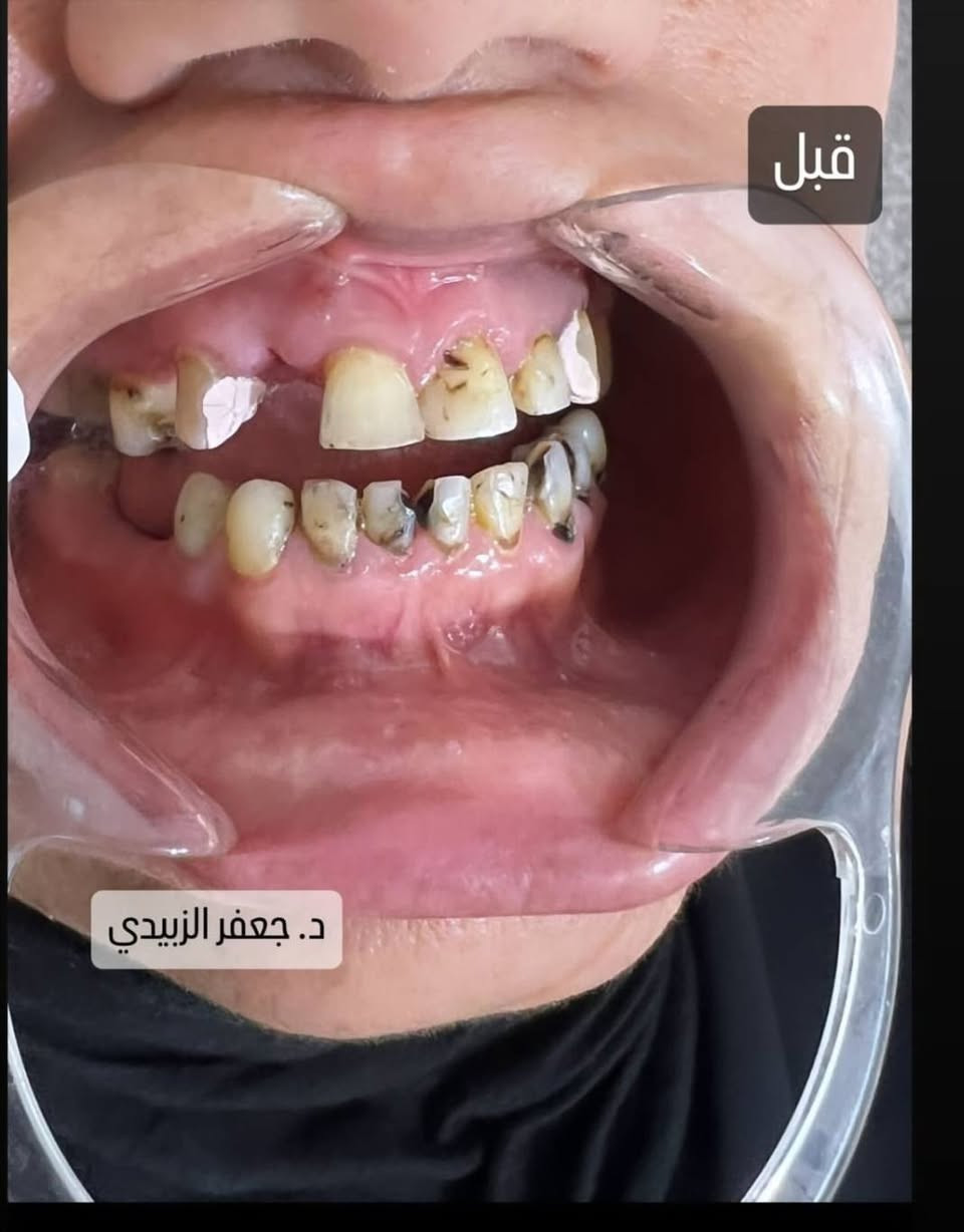 #تحيه_طيبه
سوف يتم بأذن الله التواجد في مجمع الشفاء الطبي الدبوني 
الدكتور جعفر حبيب الزبيدي
اختصاص طب وجراحة الفم والاسنان 
قلع-حشوات جذور-تقويم اسنان-تنظيف تبييض-تعويض الاسنان المفقود
#السبت_الاثنين_ليلآ
#الاربعاء_الخميس_الجمعة_عصرآ 
#الدبوني_خلف_صيدليه_زهراءمهدي
#في_مجمع_الشفاءالطبي_الدبوني
الاستفسار ***********
