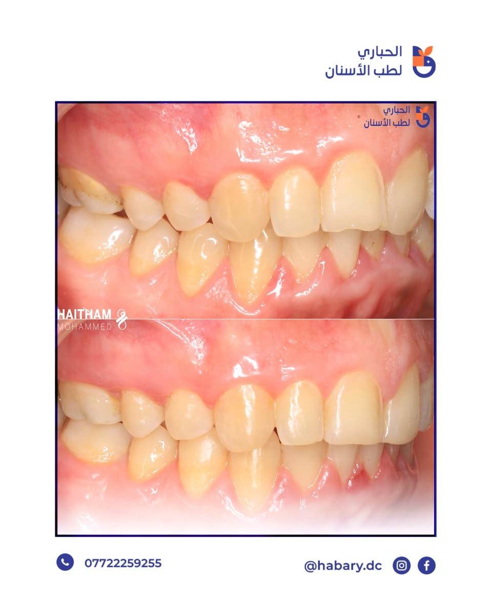 علاج العضة العميقة و تعديل إبتسامة مراجعة بتقويم الأسنان✨
المسيب - مجاور مركز صحي المسيب - مقابل مول فاملي المسيب- فوق مطعم سوبر صوص. 

رقم الحجز : ***********
