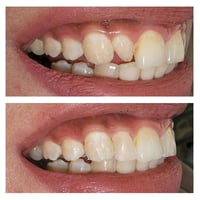 غلاف زاركون ثابت نوع فيتا الماني طبيب الاسنان الاختصاص د.عمار عباس ماج...