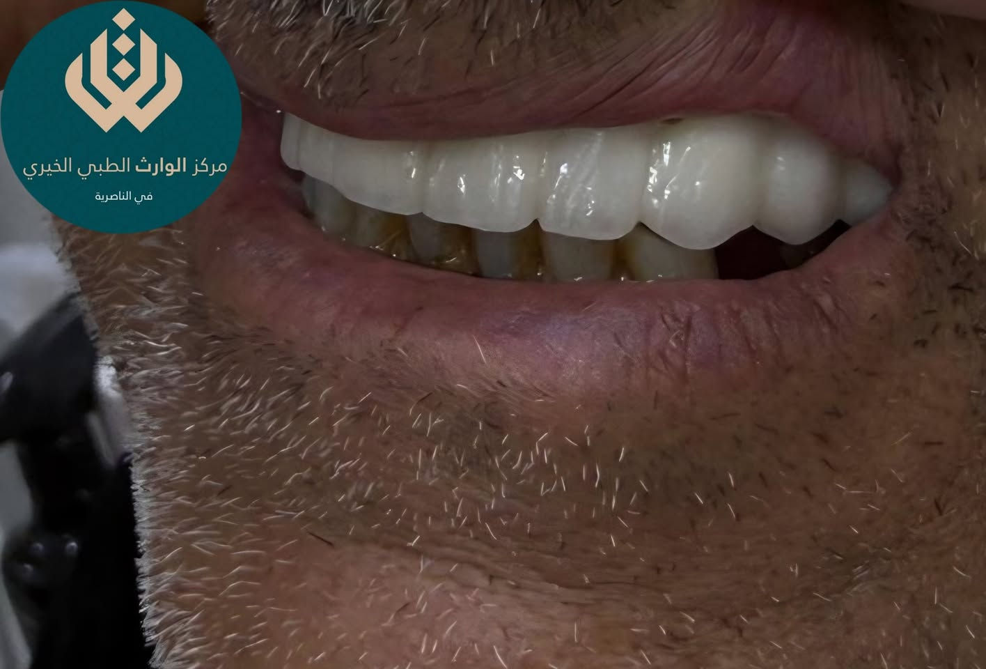 راجعنا المريض يشكو من بروز بالاسنان وتاكل بل الاسنان وفقدان الاسنان واصفرار ونخور بالاسنان 
قمنا بعمل الاجراء لازم وعمل تغليفات زيركون 
من اعمال طبيبنا المتميز🫡
د محمد السخي
📍 متواجدين يومياً طول أيام الأسبوع:
⏰ من الـ9 الصبح للـ12 الظهر
⏰ ومن الـ2:30 العصر للـ9:30 بالليل

📞 للتواصل ويانه:
✅ العيادات البشرية: ‎***********
✅ عيادات التجميل: ‎***********
✅ عيادات الأسنان: ‎***********

📍 العنوان: الناصرية – شارع بغداد، مجاور مدرسة الجواهري الأهلية
