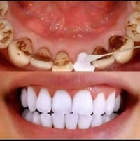 بخاخ تبييض • مبيض أسنان • للمدخنين