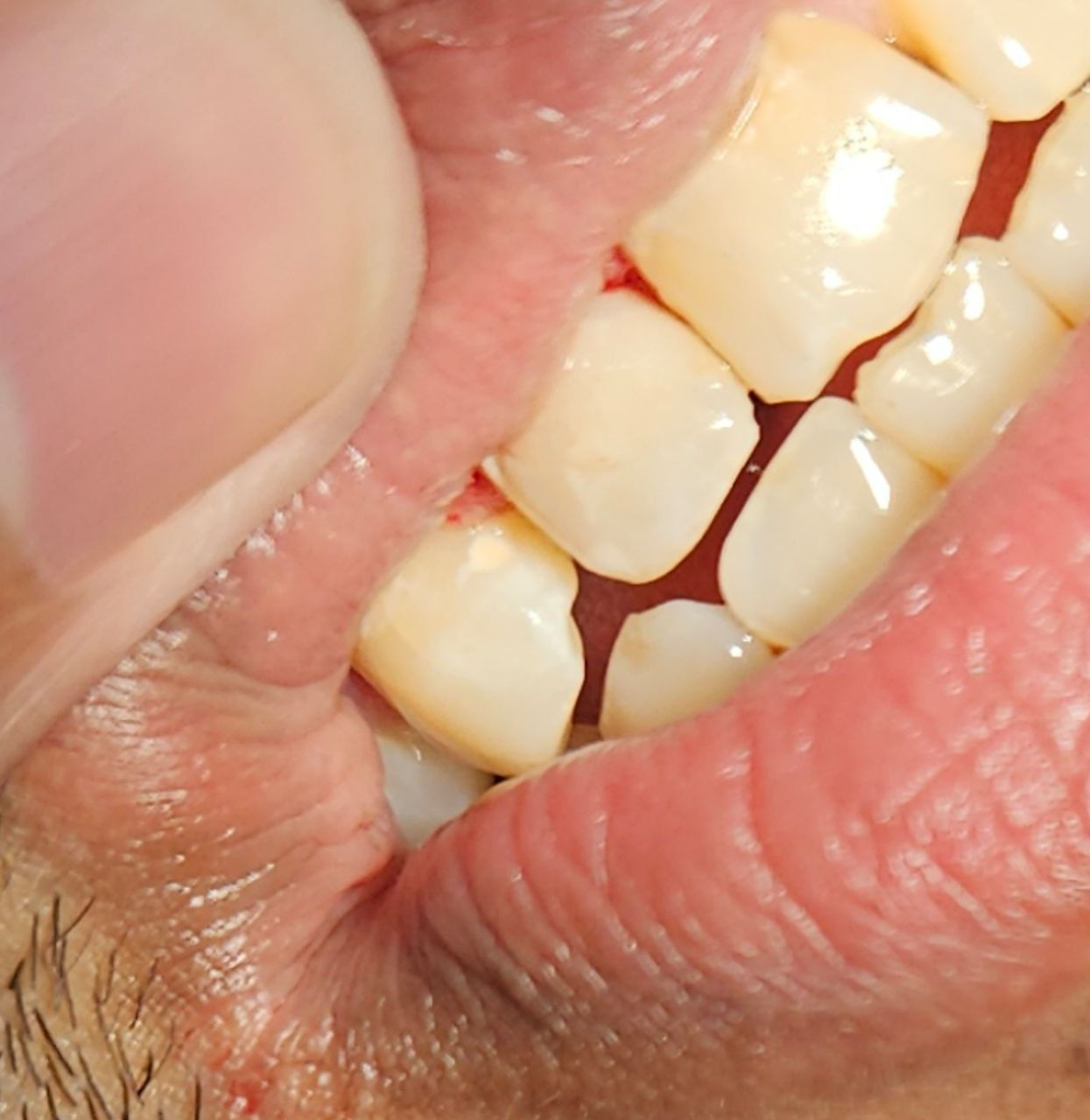 السلام عليكم

يتوفر

- قلع الأسنان والجذور

- تنظيف و تبييض الأسنان وازالة التكلسات

- تركيب تخم اسنان كامل

- حشوات و حشوات (الجذور)

-معالجة اسنان الاطفال مع جلسات الفلورايد

حشوات اسنان و قلع اسنان الاطفال

-تقويم الاسنان

جميع الخدمات (مجانا)

العنوان تقاطع القدس

التواصل خاص

او واتساب على الرقم

***********
