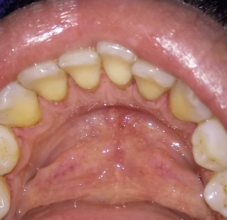 تنضيف الأسنان وازالة التكلسات والتصبغات 
(بجلسة واحده فقط) 

📍 العنوان :- حي النصر/ شارع السوق/ خلف جامع الأمام المهدي/فوق صيدلية مصطفى جاسم أو اسواق الزعيم 
***********
عيادة الفرح لطب وتجميل الأسنان
