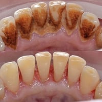 تنظيف أسنان من التكلسات والتصبغات وعلاج اللثة من الالتهاب موعد العيادة...