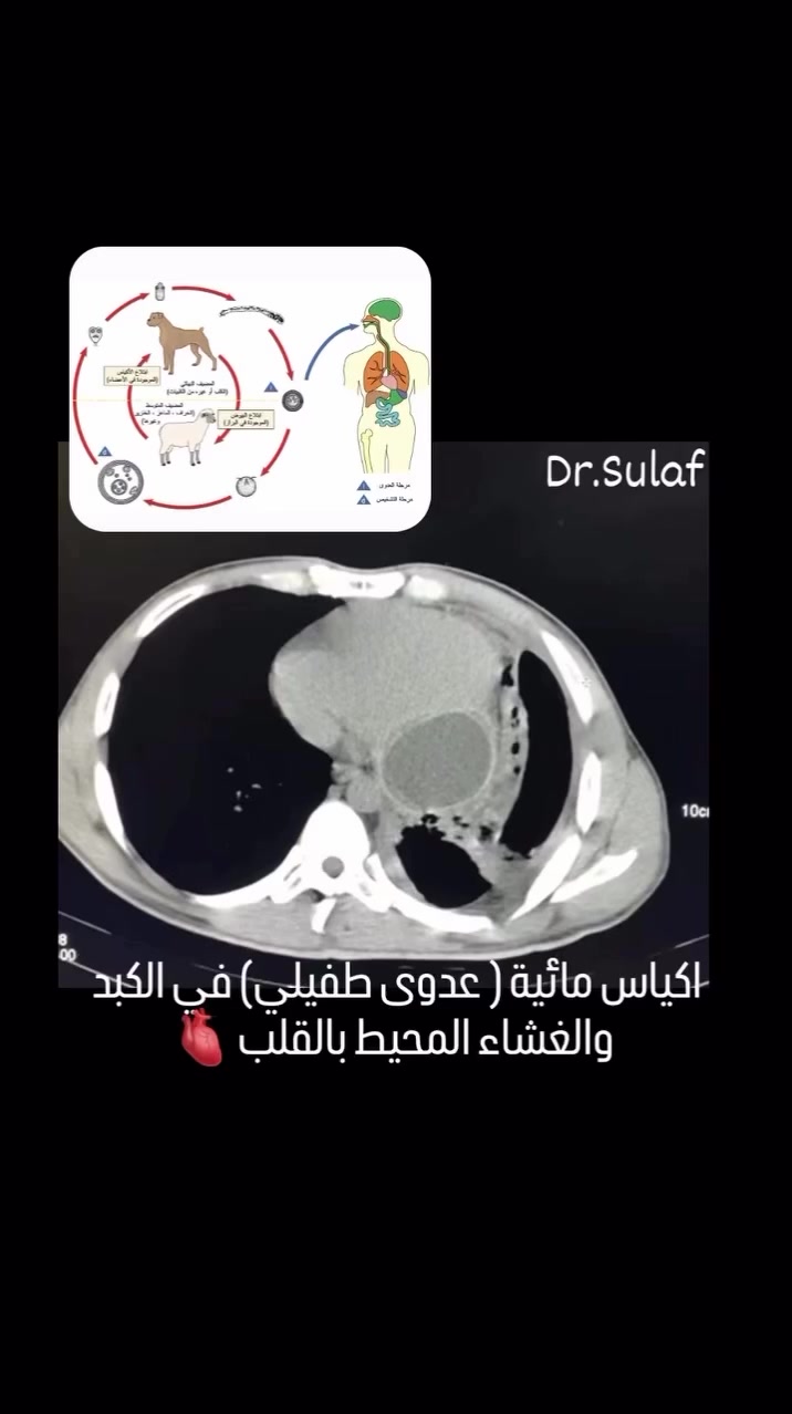 “تدري أكو طفيلي بالعراق يوصل للقلب والكبد بدون ما تحس؟ 😳

العراق يُعتبر من أكثر الدول إصابة بـ الأكياس المائية ⚠️
اليوم جايبين حالة لشاب عمره 20 سنة
فحص المفراس بيّن وجود أكياس مائية حول القلب والكبد 💔

شنو السبب؟
مو سرطان… ولا ورم…
طفيلي جاي من الكلاب!

الكيس المائي مرض سببه طفيلي اسمه
Echinococcus granulosus
ينتقل للإنسان عن طريق:
أكل أو مي ملوث ببيوض الطفيلي 🥬🚰

يدخل للجسم ➜ يوصل للكبد أو الرئة ➜
ويبدأ يكبر كيس مملوء بسائل سام

الأعراض ممكن تبقى سنين مخفية!

بس من يكبر الكيس يسبب:
▪️ ألم أو ثقل بالجهة اليمنى من البطن
▪️ انتفاخ
▪️ غثيان وتقيؤ
▪️ اصفرار بالعين والجلد
⚠️ وإذا انفجر الكيس؟
يسبب صدمة تحسسية ممكن تقتل!

التشخيص يكون بـ:

✔️ السونار (أول خطوة)
✔️ المفراس (CT) لمعرفة الحجم والمكان بدقة

⁨ 🔱 عيادة  الدكتورة سولاف سعدي الجيلاوي للأشعة والسونار 🔱
💢متواجدين طيلة ايام الاسبوع حتى الجمعة 
👩‍⚕️ د. سولاف سعدي الجيلاوي
بورد عربي (دكتوراه) أشعة تشخيصية وتصوير طبي
تدريسية في كلية الطب / الجامعة المستنصرية
💢ايام التواجد( السبت - الاحد - الثلاثاء - الخميس - الجمعة ) 
👨‍⚕️ د. محمود مشغل محمد
اختصاص أشعة تشخيصية وتصوير طبي
أستاذ في كلية الطب / جامعة بغداد
💢 ايام التواجد ( الاثنين - الاربعاء )

🩺 نقدّم جميع فحوصات السونار والدوبلر الملون و الاشعة : 
⁠• البطن (الكبد، المرارة، الطحال، البنكرياس)
• الكلى والمجاري البولية والبروستات
• الخصوبة والدوالي للرجال
• الحمل، الرحم والمبايض
• الثدي والغدة الدرقية والعنق
• دوبلر الشرايين والأوردة
. وكافة انواع الاشعة باحدث الاجهزة

📝 كتابة تقارير:
الاشعة والمفراس الحلزوني والرنين المغناطيسي

⏰ الدوام: من 4 عصراً إلى 9 مساءً

📍عيادات مريم الطبية التخصصية
🏨 بغداد حي الحسين  شارع مجمع النسيم قبل جسر العامرية مجاور متوسطة الجيل الثاني
☎️ للحجز والاستفسار الاتصال على الرقم
***********
#reels #trendingsongs #explorar #بغداد #حي_الحسين
