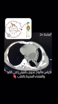 “تدري أكو طفيلي بالعراق يوصل للقلب والكبد بدون ما تحس؟ 😳  العراق يُعتب...