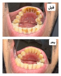 تنظيف أسنان • إزالة تكلسات • بغداد المشتل
