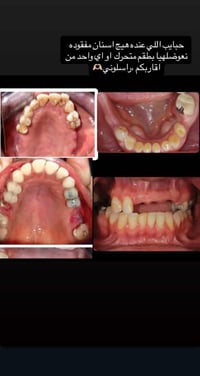الي عنده اسنان مفقوده مثل الي بالصوره راح انسويله اسنان مجاني للي محتا...