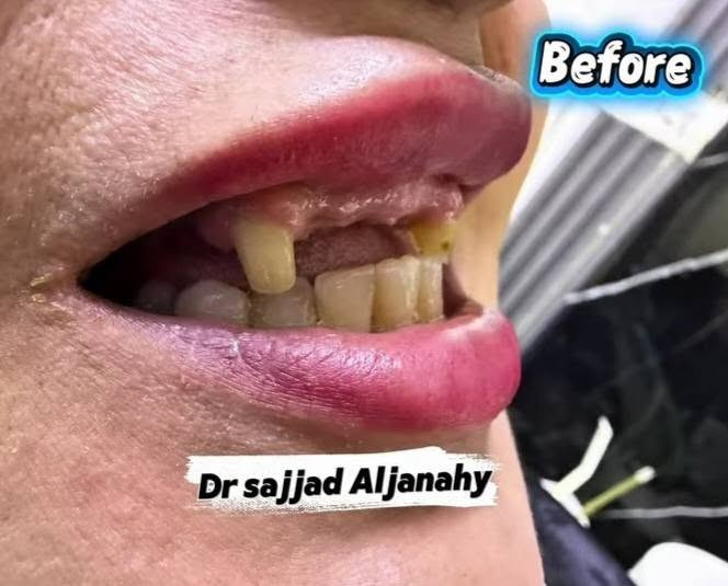 خلي ابتسامتك تبدأ ويانه! 🦷😀
تعلن عيادة الدكتور  الدكتور سجاد حسين الجناحي    Dr. Sajjad Hussain Al-janahy  عن تقديم أفضل الخدمات العلاجية والتجميلية حرصًا منا على راحتكم وصحة أسنانكم. ❤. 🦷

🔹 خدماتنا تشمل:
• تنظيف وتلميع الأسنان 🦷
• حشوات تجميلية وعلاج التسوس 🦷
• سحب العصب وعلاج الألم 🦷
• قلع الأسنان والجراحة 🦷
• تركيبات ثابتة ومتحركة 🦷
• زراعةوتقويم الاسنان 🦷
• تبييض الأسنان 🦷
• علاج لثة ونزف اللثة
• متابعة وعلاج أسنان الأطفال
وباسعار مناسبة ❤🦷

📍 العنوان: [ مجمع مجمع الحياة الطبي شارع السوداني مقابيل اسواق ابو علاء. ]
📞 للحجز والاستفسار: [***********]

🌟 لأن ابتسامتكم تهمنا… نهتم بأدق التفاصيل لنمنحكم الراحة والثقة.
 👇... 
Sajjad Al-Janahy 
دبلوم مهني تقويم الأسنان 
سيرتفيكيت زراعة الأسنان 
سيرتفيكيت تجميل الأسنان

