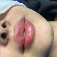 عرض رأس السنه  الفلر الكوري 65 الف عرض تنظيف بشرة مع فلر 75 الف 📍 سارع...