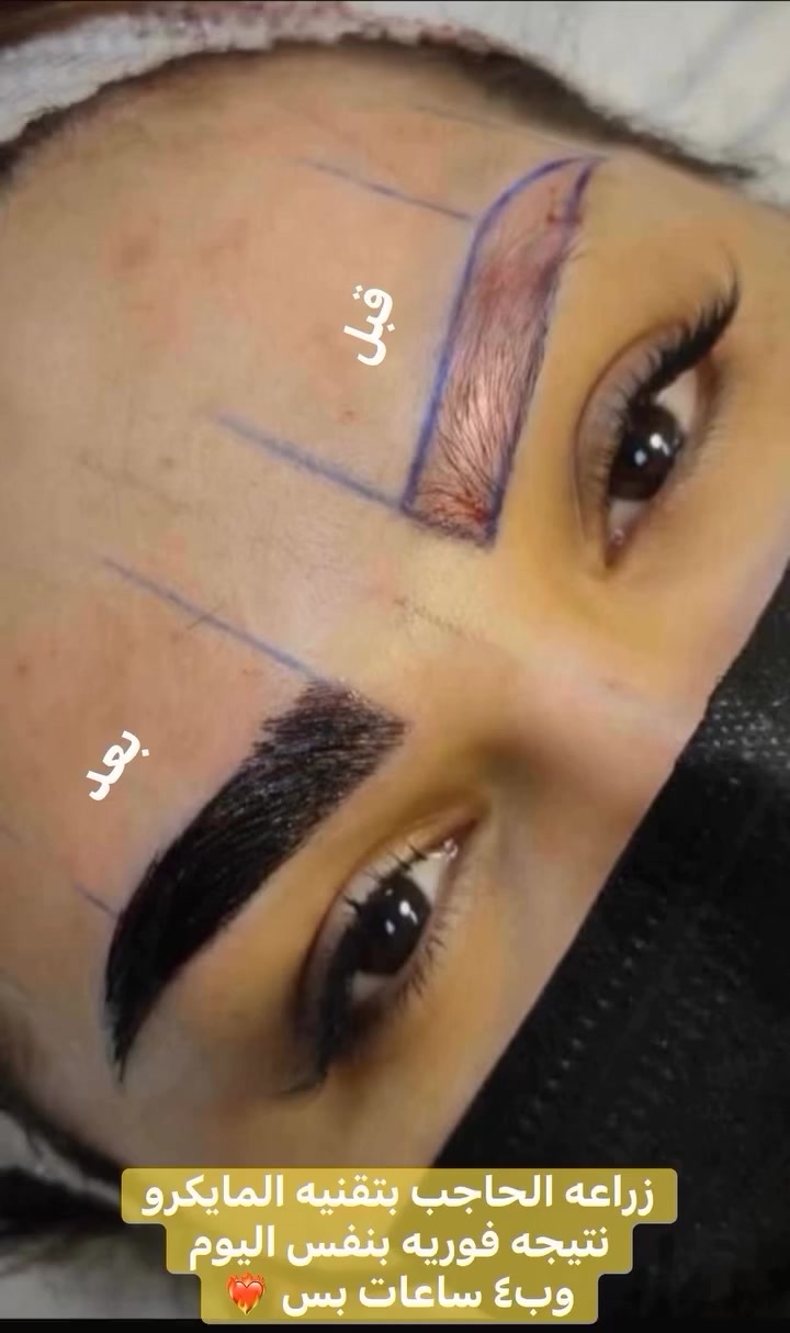 تعبتي من تاتو الحاجب وشكله كل يوم يضايقج ؟
لا لون ثابت ولا رسمه عاجبتج؟
زراعة الحاجب بتقنية المايكرو هي الحل الصح،
ترجع ترسّم الحاجب شعرة شعرة وبشكل طبيعي يليق بملامحج
والنتيجة تبين من نفس اليوم بدون انتظار ✨
لأن الجمال الحقيقي ما يحتاج تصليح كل فترة، يحتاج قرار صح �
للتواصل والاستفسار
***********
