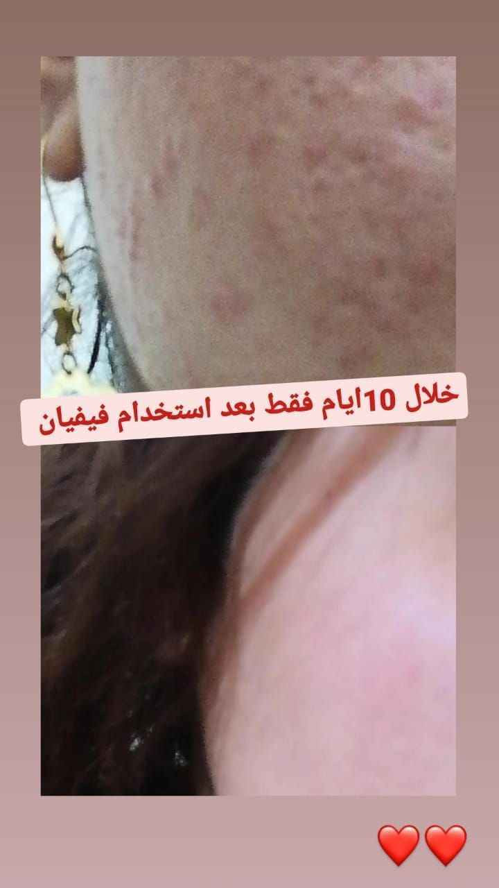 ❄️ احد اهم افضل المنتجات لتبييض البشرة ❄️
.
🟢كريم فيفيان مصنوع من 14 مادة عشبية 🍀 و6 فيتامينات  💊
.
 🎗منتج واحد يساعد علئ حل اهم 5  مشاكل للبشرة 🎗
.
يبيض البشرة - يعالج الكلف - يعالج التصبغات - يعالج الهالات التحت العين - يرطب البشرة وتصبح اكثر نضارة 
.
كريم فيفيان منتج ®️ صنع في كوريا ويعمل بسياسة 🎗 ما بعد البيع كـ  🔁 الاستبدال والاسترجاع  
.
نتيجة الكريم ثابتة ودائمية 🟢 نتائج حقيقية من اول  استخدام 🟢 بدون اثار جانبية اثناء  او بعد ترك الاستخدام  بسبب التركيبة العشبية

👈🏻💌اي استفسار او الحجز👇🏻
 ***********

#التوصيل_لجميع_المحافظات بغداد, العراق
