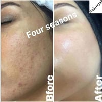 💥تقنيه #البيبي_كلو 💥 Baby glow   مواد بيبي كلو هي مواد طبيعيه تجميليه ...