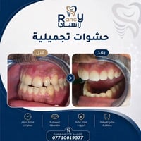نعيد صياغة الابتسامة... حشوة تلو الأخرى. 🪄✨"