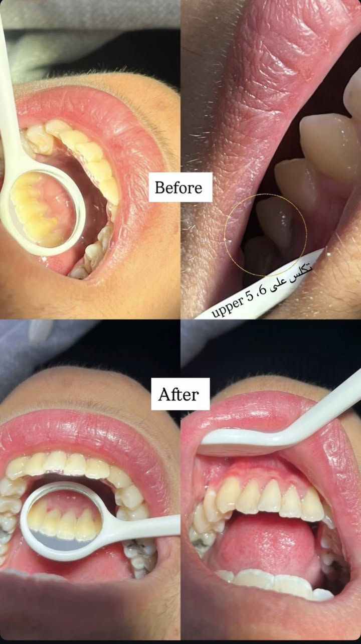 الي محتاج تنظيف اسنان او حشوات او تعويض اسنان بطقم متحرك يراسلني ع الواتساب  والشغل مجاناً 
***********
