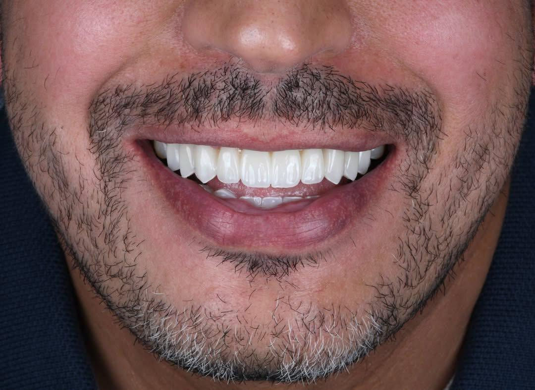 في مركز ماسة الحسينية التخصصي لطب وجراحة الفم والأسنان

دلل نفسك بابتسامة تليق بك.. ابتسامة المشاهير في مركز 
ماسة 👑

متوفر أقساط منصة الرافدين ومنصة الرشيد لتسهيل الدفع على الجميع.

🎁 (الفحص والاستشارة مجانية تماماً).
📲 الحجز مفتوح هسة عبر الواتساب، راسلنا مباشرة وخلي الباقي علينا:
📞 ***********
📍 العنوان: بغداد - الحسينية - شارع عشرين - مجاور السوق الأول
