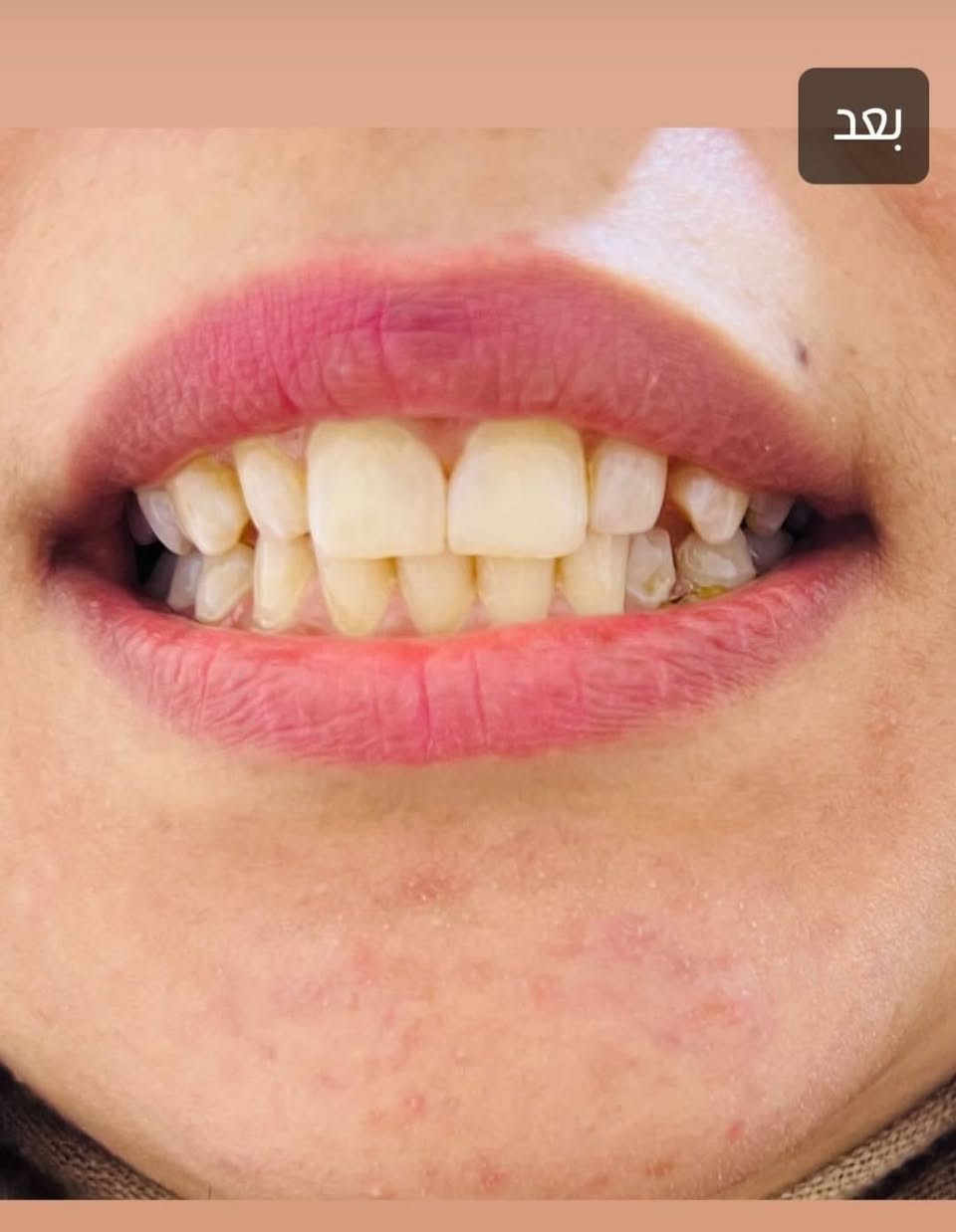 #تحيه_طيبه
سوف يتم بأذن الله التواجد في مجمع الشفاء الطبي الدبوني 
الدكتور جعفر حبيب الزبيدي
اختصاص طب وجراحة الفم والاسنان 
قلع-حشوات جذور-تقويم اسنان-تنظيف تبييض-تعويض الاسنان المفقود
#السبت_الاثنين_ليلآ
#الاربعاء_الخميس_الجمعة_عصرآ 
#الدبوني_خلف_صيدليه_زهراءمهدي
#في_مجمع_الشفاءالطبي_الدبوني
الاستفسار ***********
