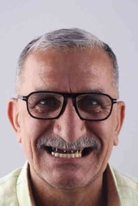 زراعة اسنان فورية • خصم50% • الديوانية سوق العروبة