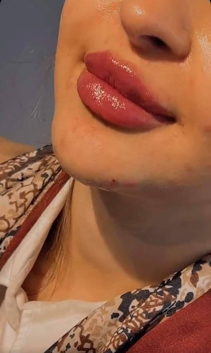 #فيلر_شفايف_بسيط_شغل_الدكتورةصابرين  #فلر_شفايف #عيادة_تجميل #صالون #الروان #العنوان #كربلاء #قنطرة #السلام #الحجزوالاستفسار #على #واتساب***********

متوفر الدفع عن طريق البطاقة المصرفية💳💳
