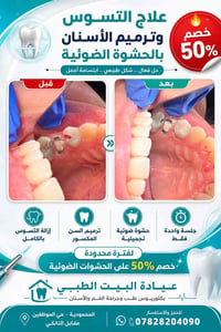 حشوات ضوئية • إزالة تسوس • المحمودية
