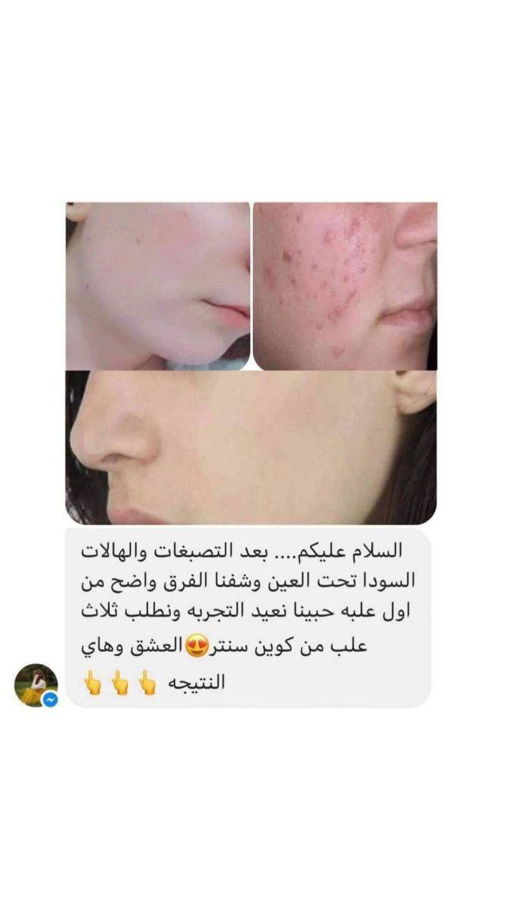 😍◀️ بكج العناية الكاملة بالبشرة من كوين سنتر والمناسب لكلا الجنسين 💯
⚘️ كريم كوين الليلي +وسيروم فيتامين c + صابونه الكولاجين ⚘️

راح تلاحظون تغيير سحري بشرتكم من اول اسبوع 🥰👌
💢 مع ضمان نتيجه رهيبه وتبين نتيجة خلال الأستخدام 💢
 #كوين_سنتر 🥰👌

للطلب والاستفسار يرجى مراسلة الصفحة🛍️


**إذا كنت صاحب هذا الإعلان وتريد حذفه لأي سبب، رجاءا أرسل رسالة إلى الدعم الفني**