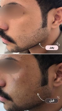 الغربي مجاور الاطفاء • عيادات بيوتي كلنك • علاج الحبوب