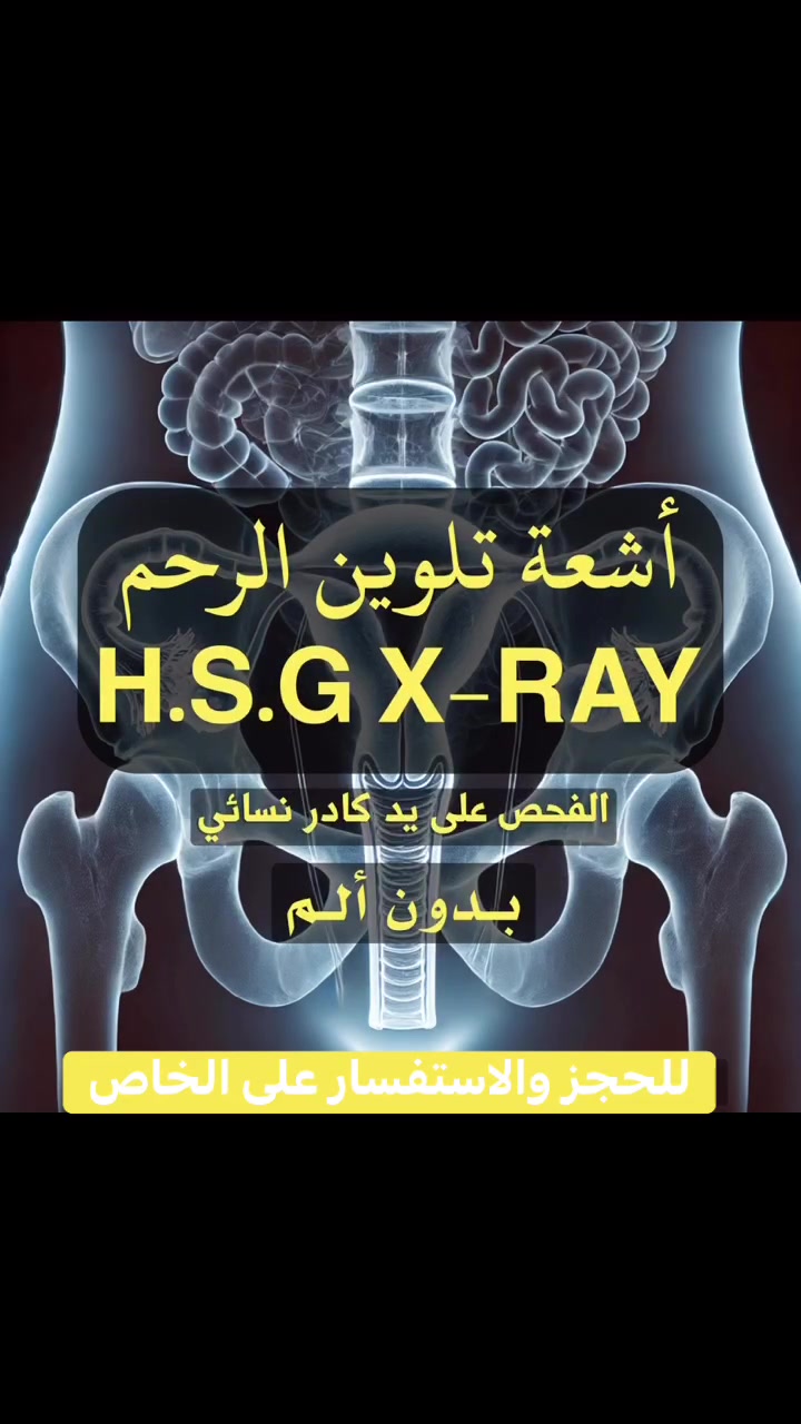 الأشعة الملونة للرحم والأنابيب    (H.S.G)
هو فحص بالأشعة السينية للرحم، حيث تُلتقط صورة للرحم وقنوات فالوب بعد ملئهما بالصبغة،
من فوائد هذا الفحص:

• تشخيص مشاكل تأخر الحمل: لفحص أسباب تأخر الإنجاب بدقة .
• كشف الالتصاقات أو التشوهات: تقييم الحالة الصحية للرحم بشكل كامل .
• فحص انسداد قنوات فالوب: التأكد من سلامة القنوات لضمان مرور البويضة.
• تقييم شكل وبطانة الرحم: لضمان بيئة مثالية لاستقبال الجنين .

الحجز والاستفسار: التواصل عبر رسائل الصفحة (الخاص)

#الاشعة_الملونة_للرحم
 #الحمل 
#اشعه
 #العقم #انسداد_قنوات_الرحم
#بغداد_الطالبية_الشعب_حي اور_مدينة الصدر


**إذا كنت صاحب هذا الإعلان وتريد حذفه لأي سبب، رجاءا أرسل رسالة إلى الدعم الفني**