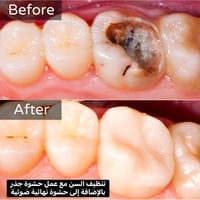 حتى أصعب الأسنان متصعب علينا ✨🦷 شغلنا مو بس علاج… شغلنا دقة ونتيجة تخل...