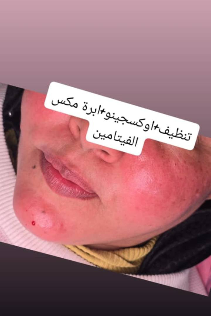 سلام عليكم دكتوره ايرانيه ابو رمانه اسعارهه مناسبه رجال ونساء تشتغل جراحه همين ابو رمانه ***********
