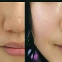 تبيض • شد البشرة • إزالة الكلف