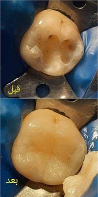 علاج تسوس • عيادة اسنان • الرمادي الصوفية