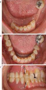 تعويض الاسنان مجاناً ٠٧٧١١٦٧٠٢٩٧